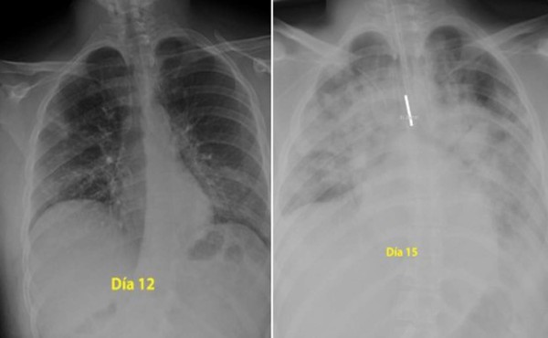 Imágenes muestran como quedan los pulmones en pacientes con coronavirus