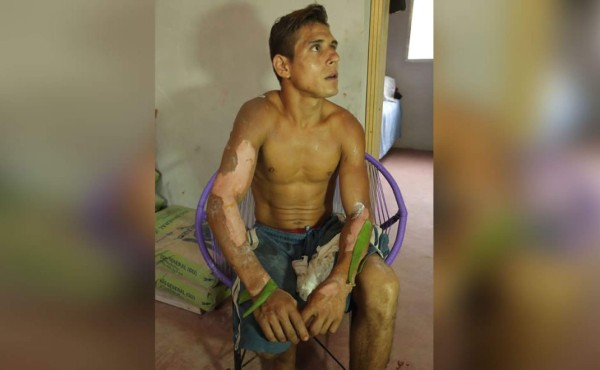 El joven que arrebató del fuego a una niña en Villanueva, Cortés
