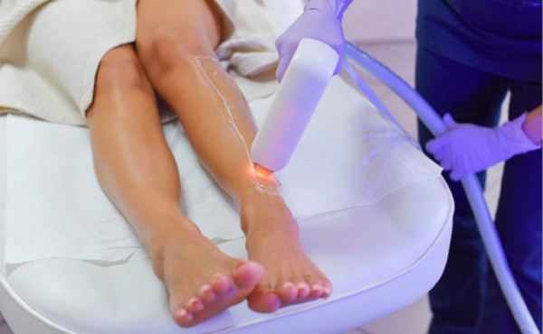 Depilación láser: elimina los vellos indeseados