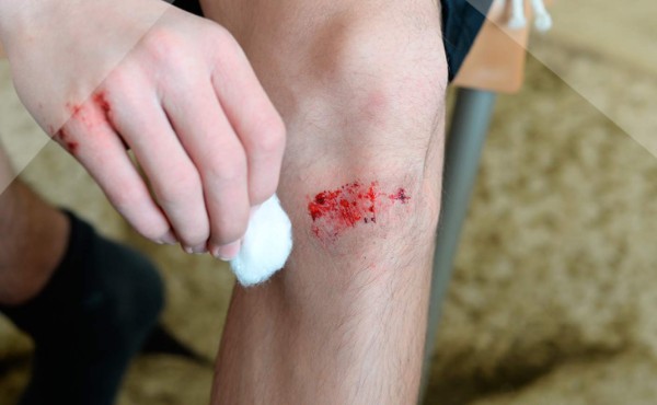 ¿Cómo curar pequeñas heridas?&nbsp;&nbsp;