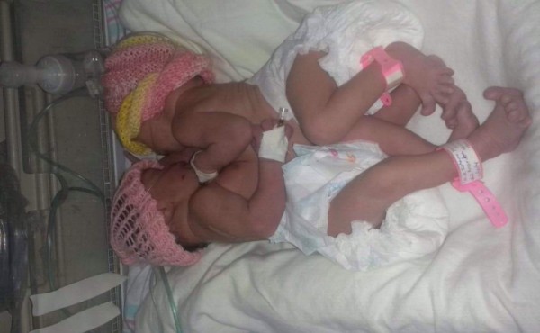 Mueren siamesas que nacieron hace 10 días en San Pedro Sula