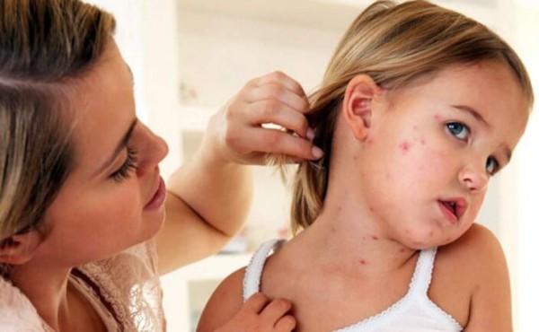 ¿Qué hago si mi hijo tiene varicela?