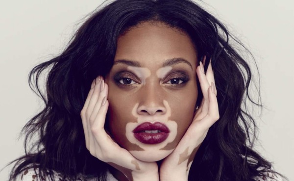 Cuba descubre la cura para el vitiligo