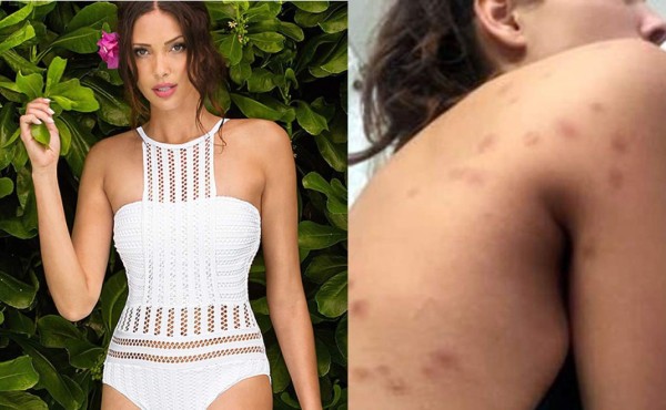 Modelo demanda a hotel al ser picada por chinches