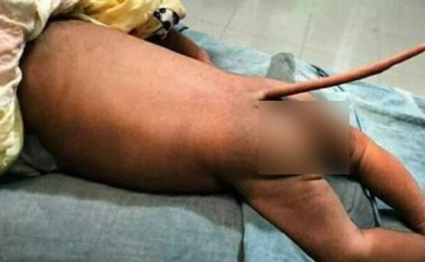 El extraño caso del niño que nació con cola de ratón en Colombia