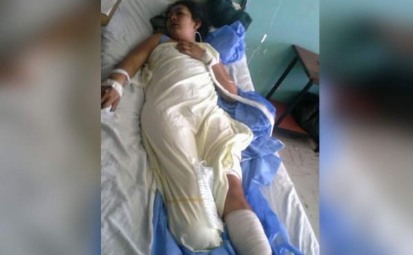 Hondureños pueden ayudar a mujer que esposo le cortó sus pies