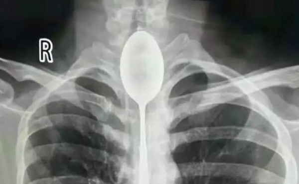 Se traga una cuchara de 20 centímetros y la sacan un año más tarde