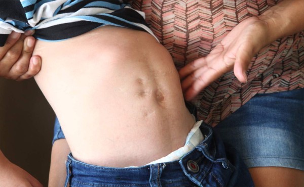 Hondureña lucha por mantener vivo a su hijo que no mira, no camina y tiene hidrocefalia