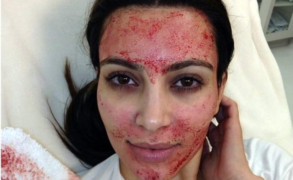 Lo que debes saber del facial 'vampiro”