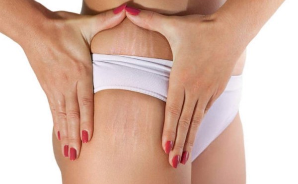 Productos estrella para desvanecer estrías