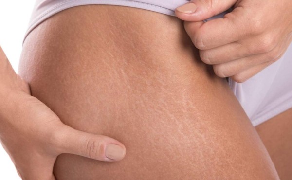 ¿Cómo funciona la vitamina E para las estrías?
