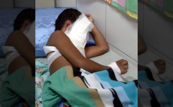 En 15 días reportan cuatro quemados por pólvora