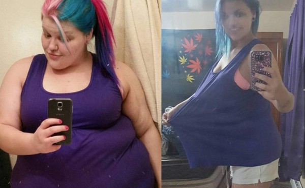 Perdió 185 libras pero su piel la hace infeliz, mira cómo luce