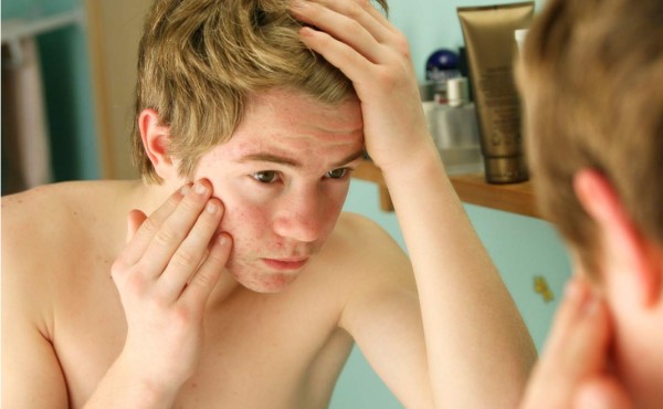 Adolescente atormentado por el acné