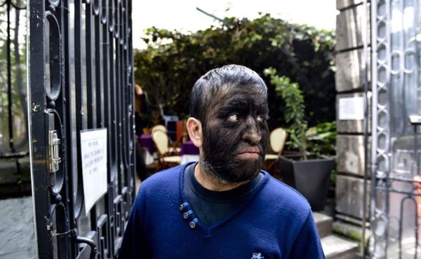 España: Niños contraen 'síndrome del hombre lobo' por una medicina errónea