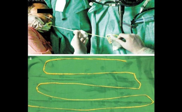 Una solitaria de 1,8 metros de largo salió por la boca de este hombre