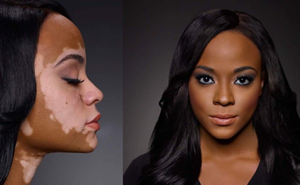 El cativí, mal que afecta la dermis