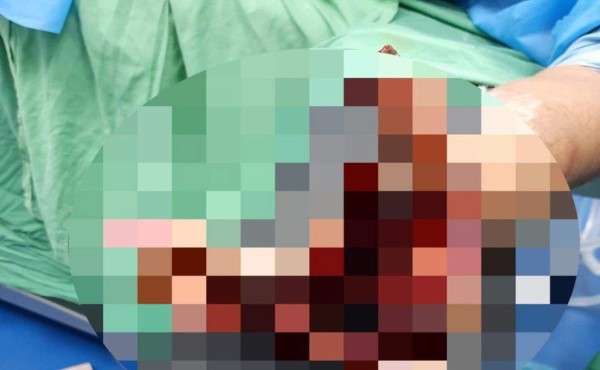 Mujer pierde tres dedos de una mano tras explotarle un mortero en Choluteca