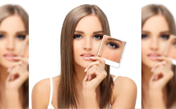 Sugerencias para ganarle la batalla al acné