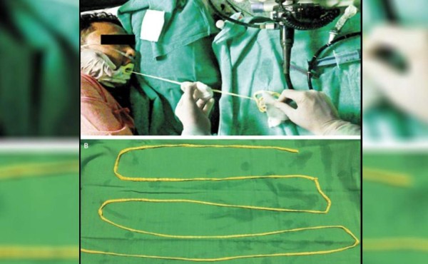 Una solitaria de 1,8 metros de largo salió por la boca de este hombre