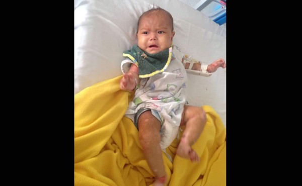Bebé hondureña con 'piel de mariposa' urge de ayuda