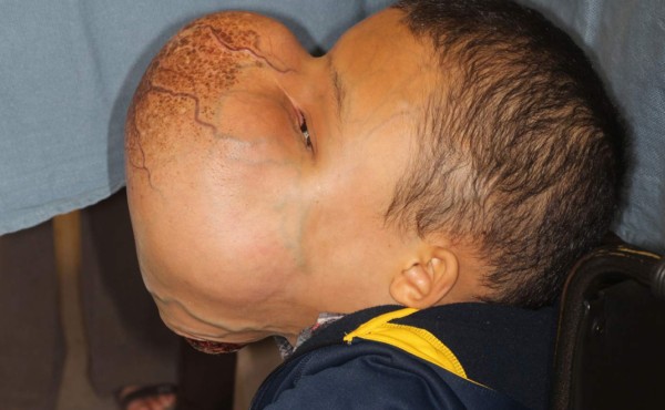 Operarán un tumor facial de 10 libras a un niño hispano en USA