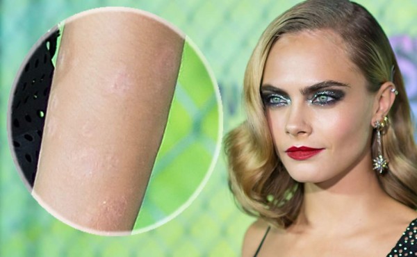 Cara Delevingne ya no puede esconder su enfermedad en la piel
