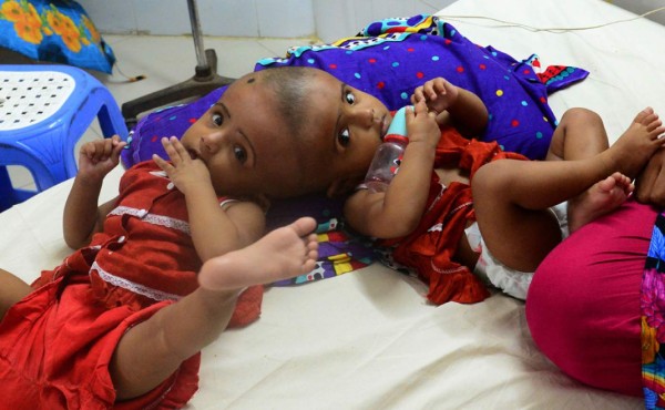 Gemelas unidas por el cráneo serán separadas