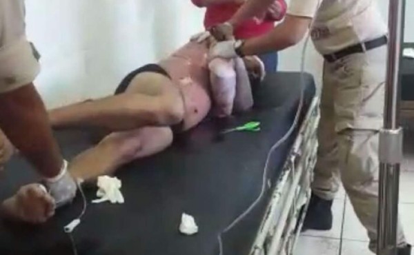 Empleado de Hondutel con graves quemaduras al rozar cable