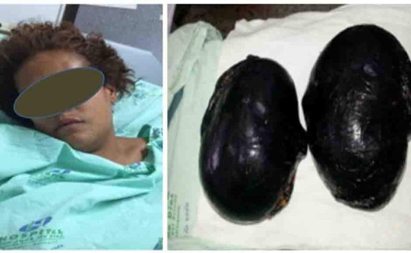 Capturan en Colombia a mexicana con cocaína en implantes mamarios