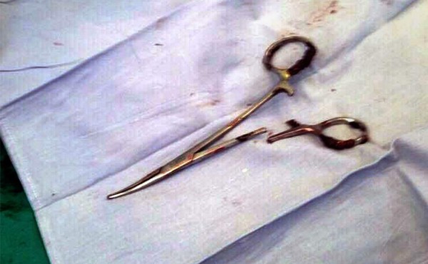 Hombre permaneció 18 años con unas tijeras 'olvidadas' en su estómago