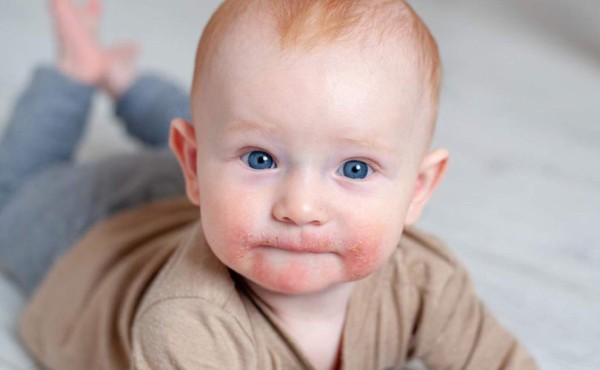 ¿Cómo calmar la dermatitis atópica?