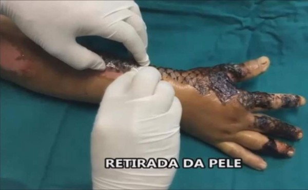 Los doctores ya concluyeron la segunda fase clínica, en la que fueron atendidos 60 pacientes con quemaduras de segundo grado, y está previsto que comience ahora la última etapa de la investigación, con 120 adultos y 30 niños. EFE