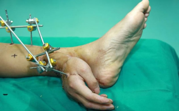 Vídeo: Le implantan una mano en el tobillo para mantenerla con vida