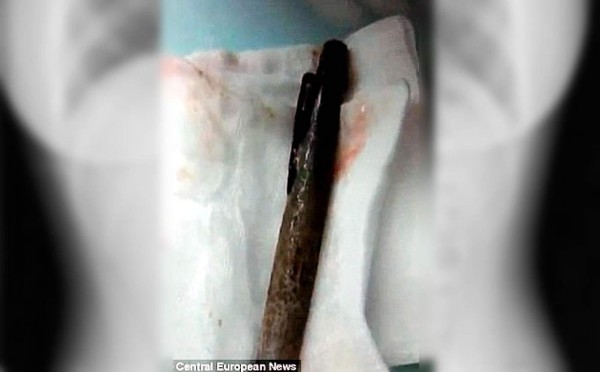 Le diagnostican depresión cuando tenía bolígrafo en el estómago