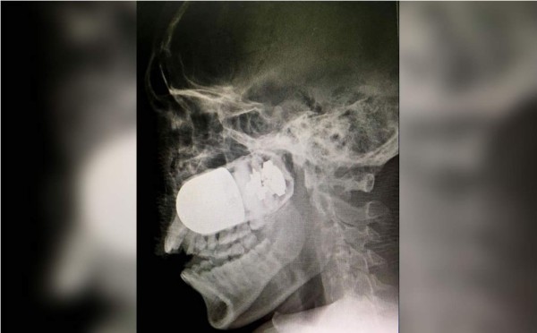 Extraen una granada de la cara de un soldado colombiano en un aparcamiento