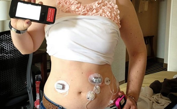 'Páncreas biónico' usado desde un iPhone combatiría la diabetes