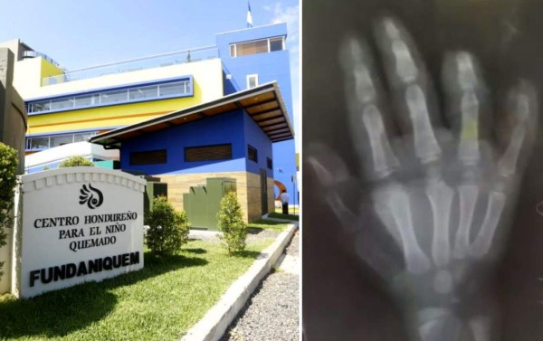 Le amputan dos dedos a niño tras explotarle mortero en la mano