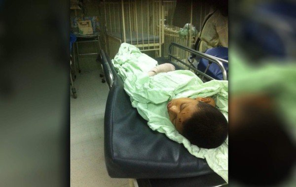 Menor de 11 años ingresado con quemaduras por pólvora