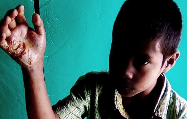 Padrastro, a la cárcel por quemarle la mano a niño