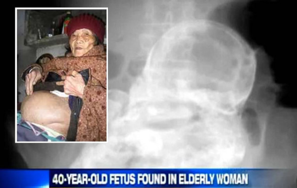 Anciana descubre que lleva dentro un feto desde hace 44 años