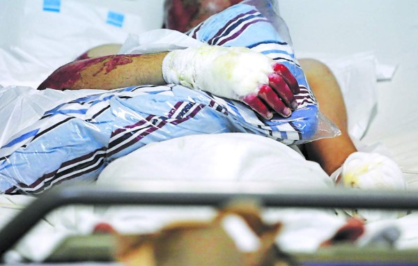 Tres adultos y dos menores luchan por su vida en el Hospital Escuela