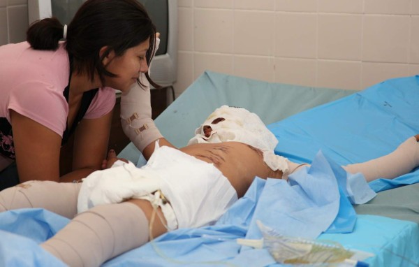 El 98% de las quemaduras en los niños se da por puro descuido