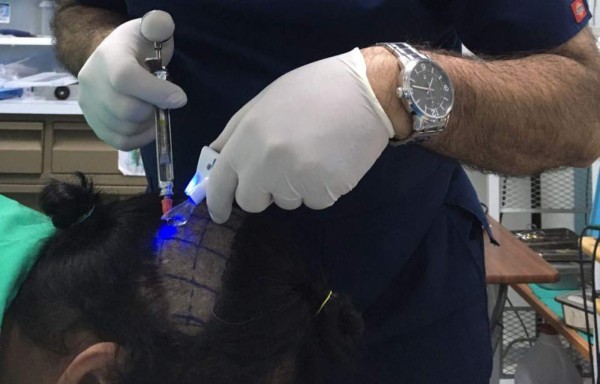 Hombres mejoran su autoestima con trasplante de cabello