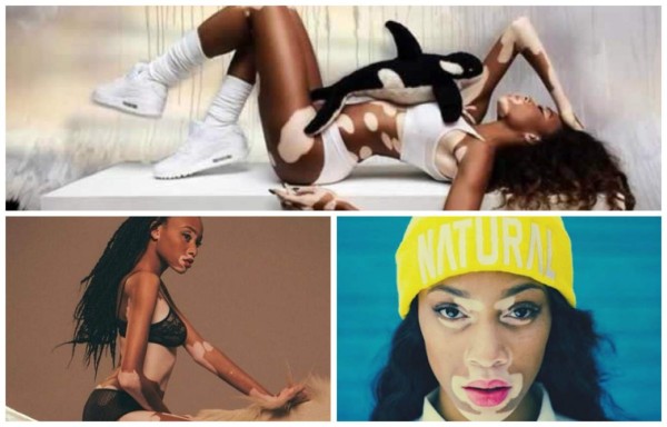 Video: Conoce a la primera modelo en el mundo que padece de vitíligo