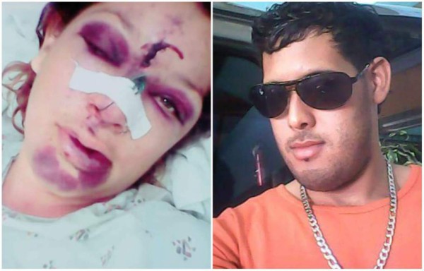 Hondureña golpeada por su pareja sale del hospital