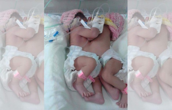 Siamesas nacidas en el Rivas comparten hígado y corazón