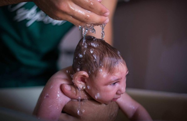 Brasil confirma más de 5,000 casos de microcefalia