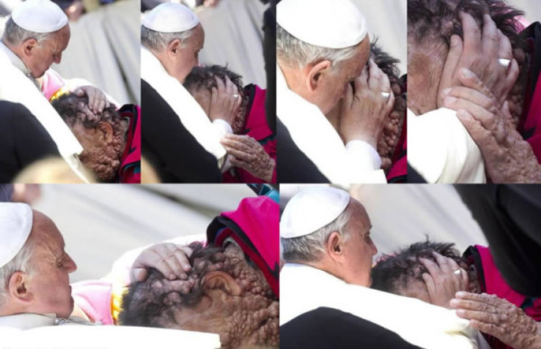 Papa Francisco bendice otra vez a un hombre con rostro desfigurado