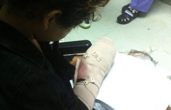 Una joven pierde cuatro dedos por pólvora en Honduras